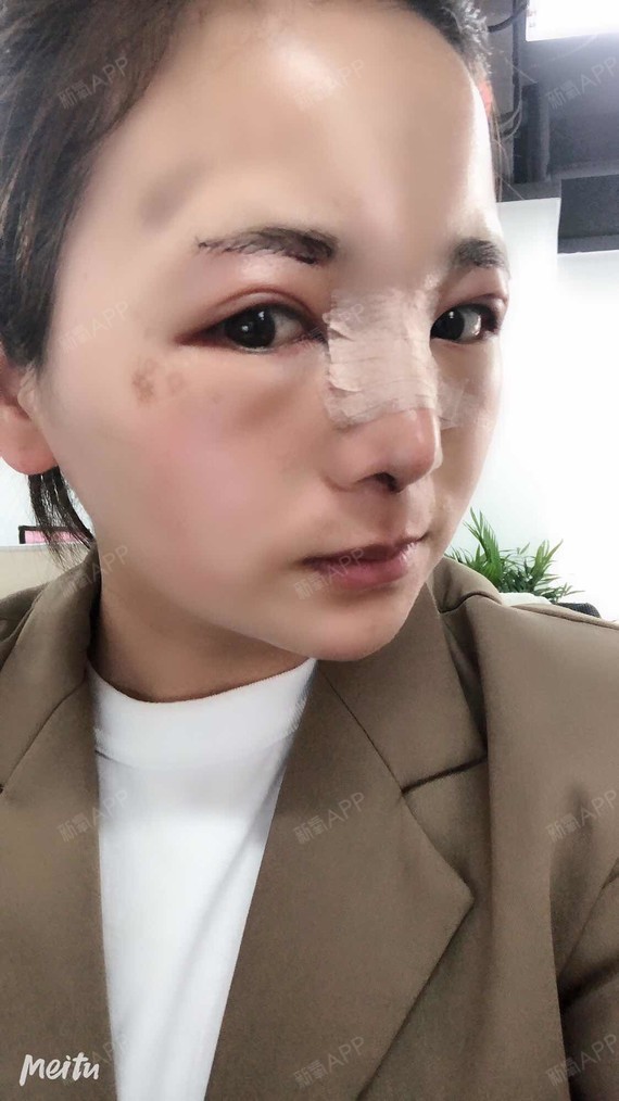 这是术后三天的照片哦~~做了提眉和隆鼻之后,刚开始