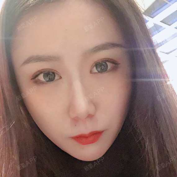 双眼皮手术后出现了眼窝凹陷问题,怎么办?