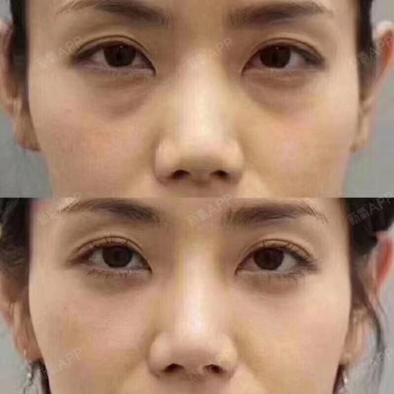 同时收紧眶隔及眼轮匝肌,适合于皮肤松弛且下睑中重度膨隆者