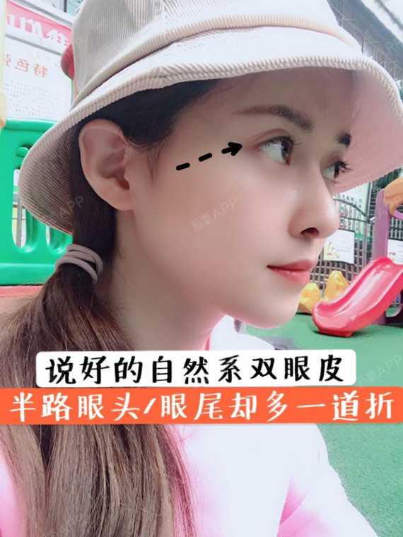 做的双眼皮扯拐啦!眼尾开叉出一道折,正常吗?
