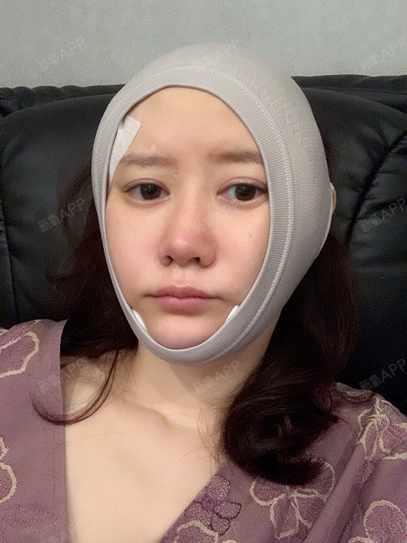 拉皮手术提升项目术后第3天        比起医院里其他做脸骨的