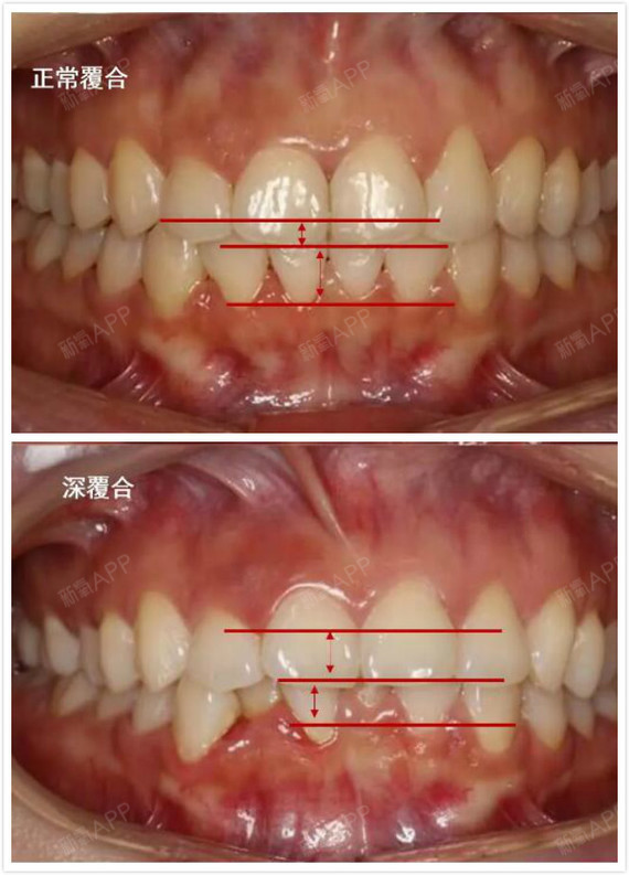 牙齿深覆合是什么样子的,如何判断牙齿深覆合?92