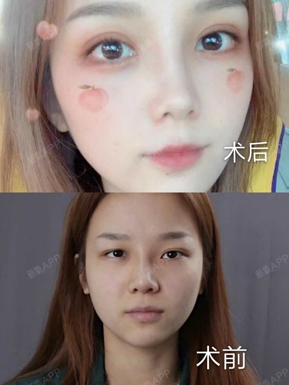 原先做过一次双眼皮哦,就是那种最简单的,现在来修复大小眼的问题.