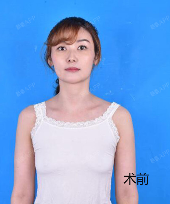 【涨点知识】假体隆胸是选择圆形还是水滴形?
