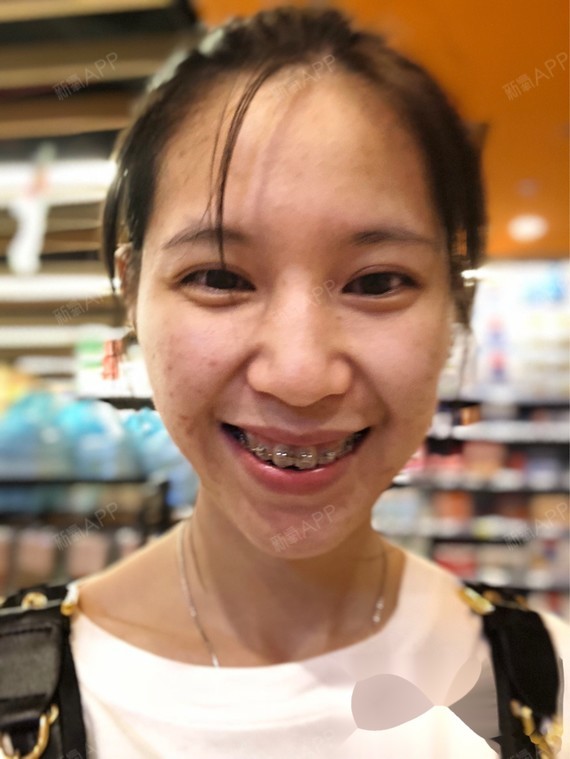 我的牙主要是很挤,上下都是右边牙挤歪了,笑起来门牙.