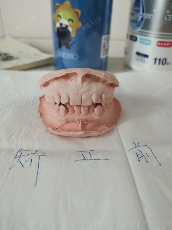 矫正前正面 牙齿变形后!向丑靠近