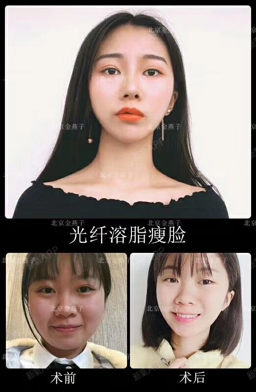【北京金燕子】还在因为脸大而发愁?光纤溶脂瘦脸,打造气质v脸型!