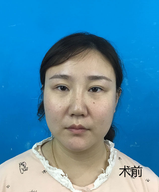 【涨点知识】面部吸脂拯救你的大胖脸