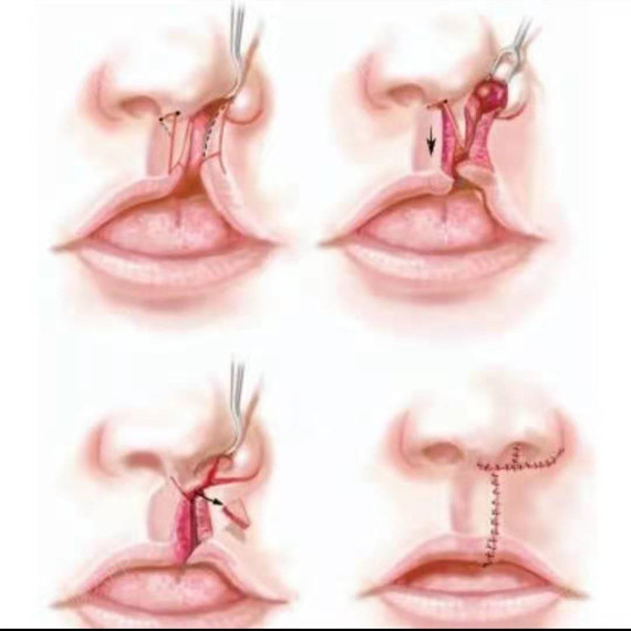 唇裂唇畸形是可以修复的
