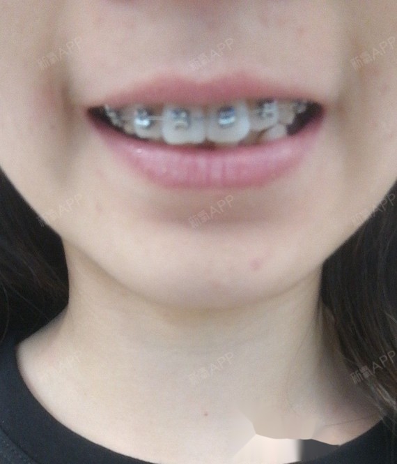 这个我太有发言权了,我的牙齿是上面鲍,下面不齐,以