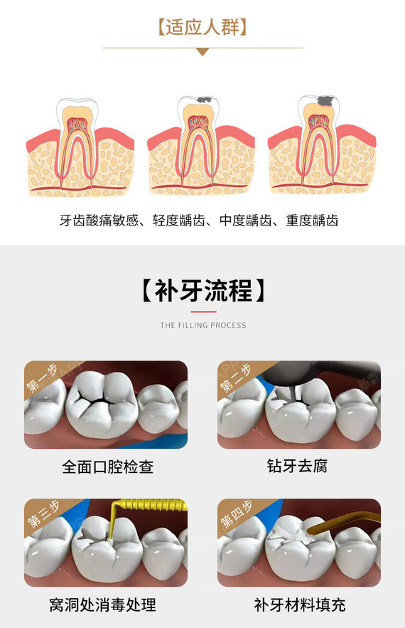 【补牙】 进口玻璃离子充填修复牙齿 色泽自然 安全舒适 99元/颗