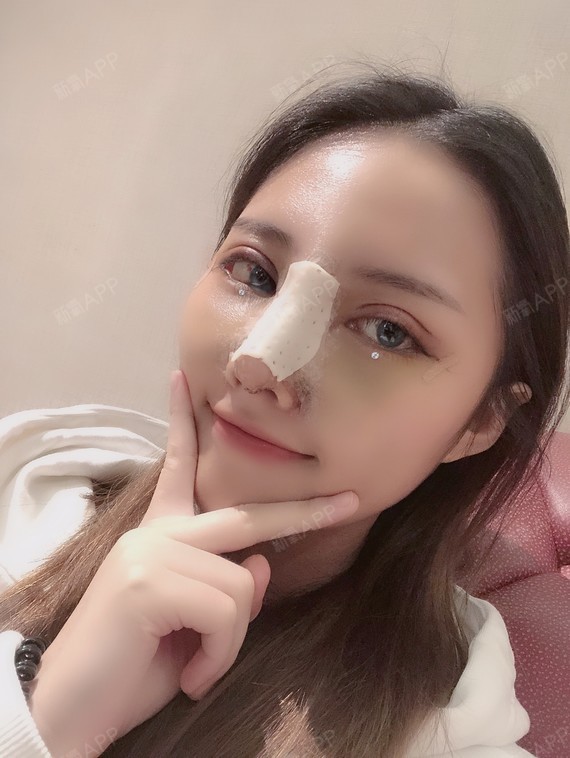 眼窝凹陷的姑娘,割双眼皮一定要另行抽脂填充眼窝?来