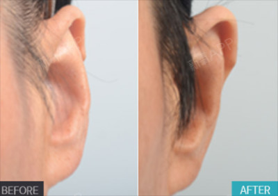 韩国贴脑耳整形方案曝光,改善看不到耳朵效果显著!