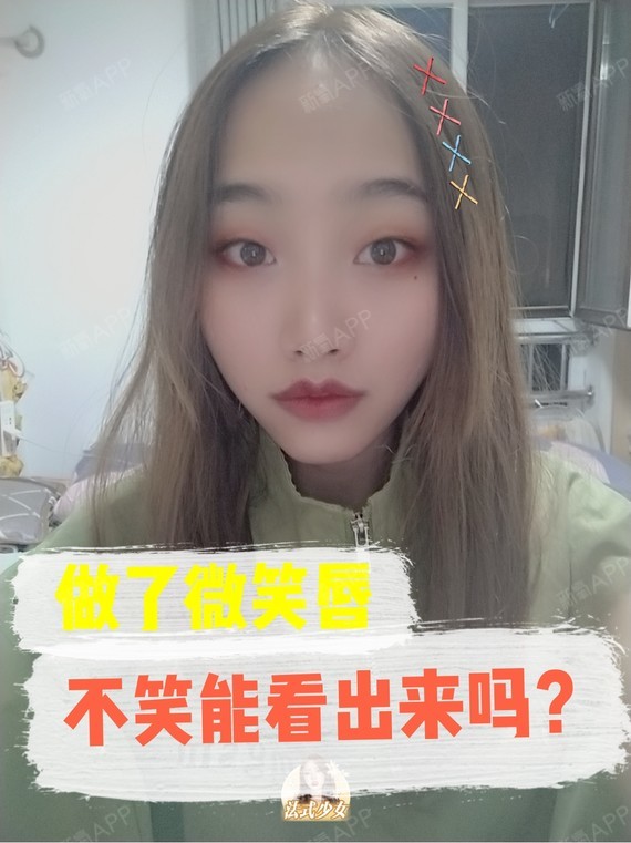 做了微笑唇后,不笑的时候能看出来吗?