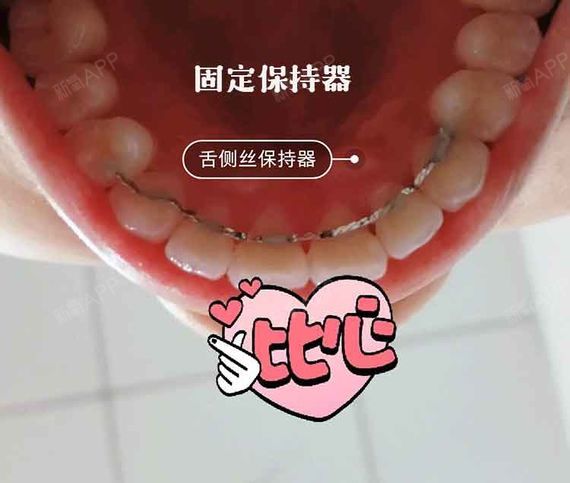 为什么牙齿矫正完成后还要戴保持器?