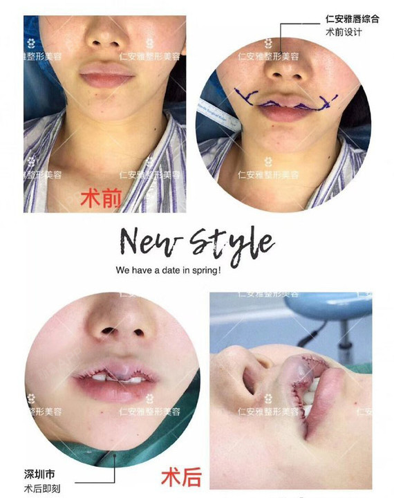 出方案的女领导 查看 【厚唇改薄】上/下改薄2选1 【元宝唇】可做m唇