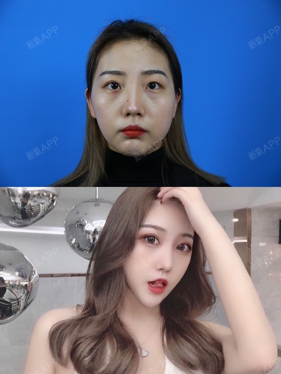 为什么有的人开眼角,反而变丑了?