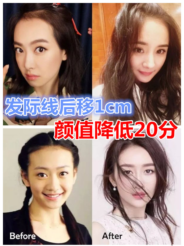 娱乐圈女星的颜值遭"发际线"拖后腿的太多了,就连当初因为可爱"发际