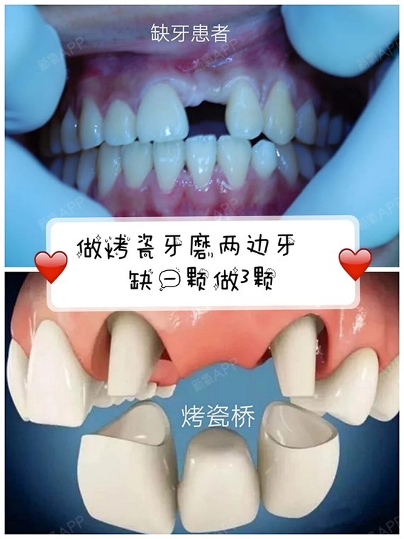 牙齿不齐选择烤瓷牙就是个坑!