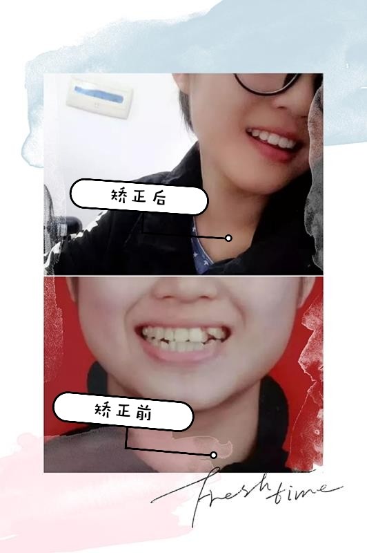 牙齿矫正比起颜值我更关注的还是咬合健康