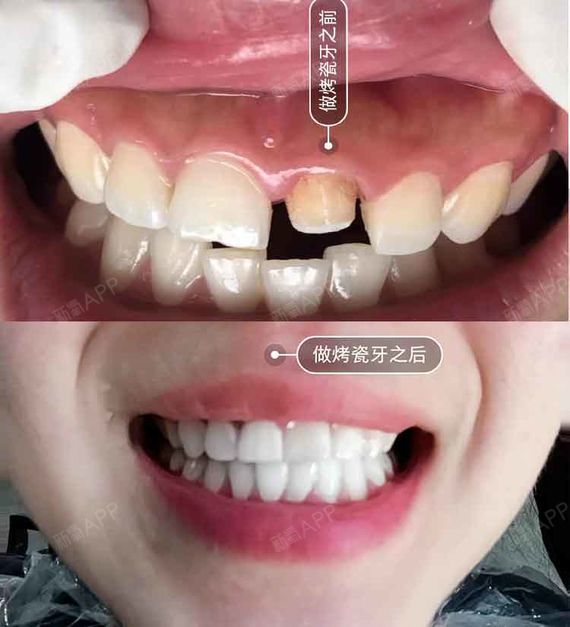 牙齿缺失有哪些镶牙方式?