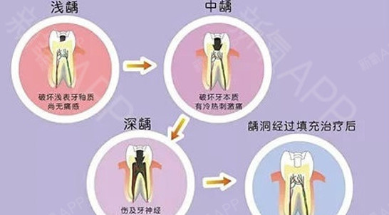 龋齿对牙齿的破坏,大多由表向里逐渐发展,临床上分为浅龋,中龋,深龋.