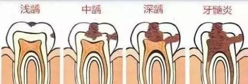 所以 浅龋—细菌攻到了牙釉质层,压根儿不会痛.