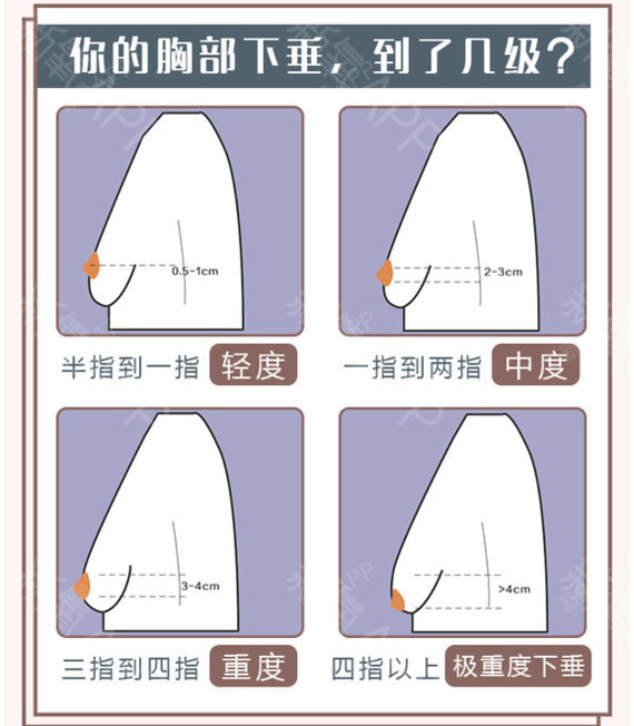 乳房下垂?都是地球引力的错?