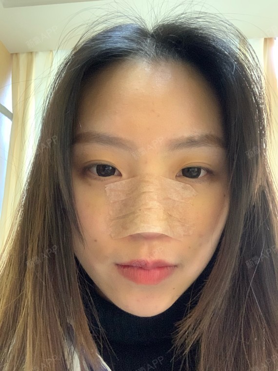 不仅鼻子肿,脸也是肿着的,鼻子两侧脸颊那应该是因为刚刚换胶带扯动