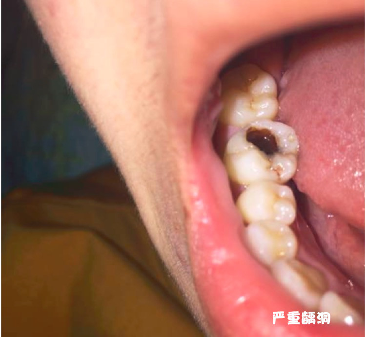 【牙疼为什么要抽掉牙神经?做次根管治疗大概花多少钱?】