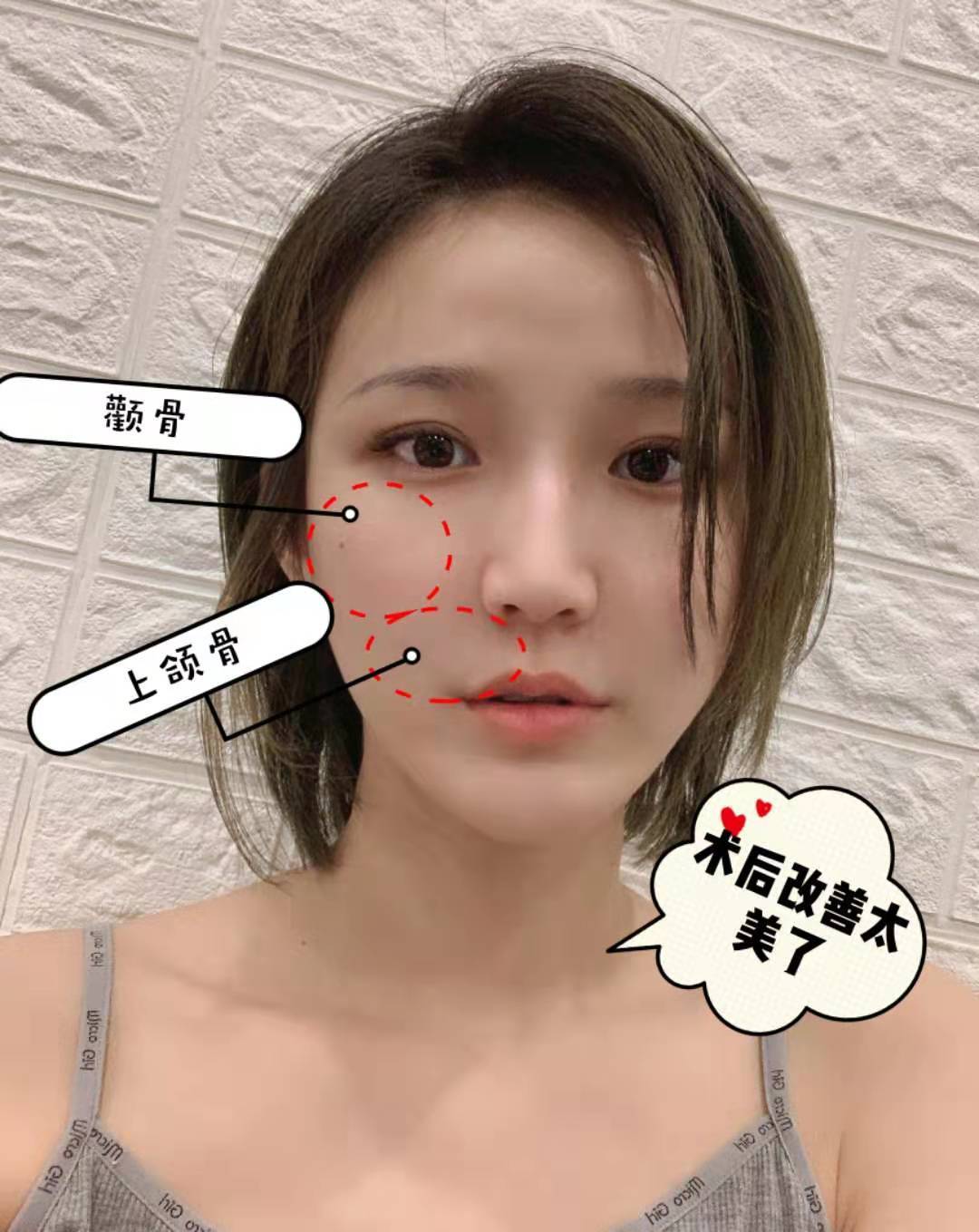 骨性法令纹是什么?垫高鼻基底也解决不了?