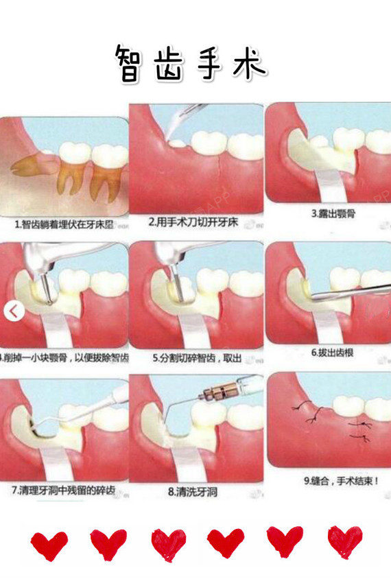 智齿患者求抱抱