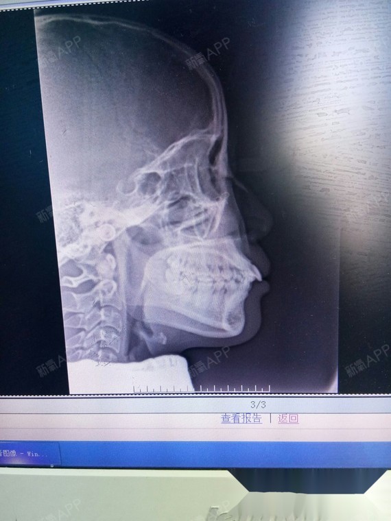 牙齿矫正