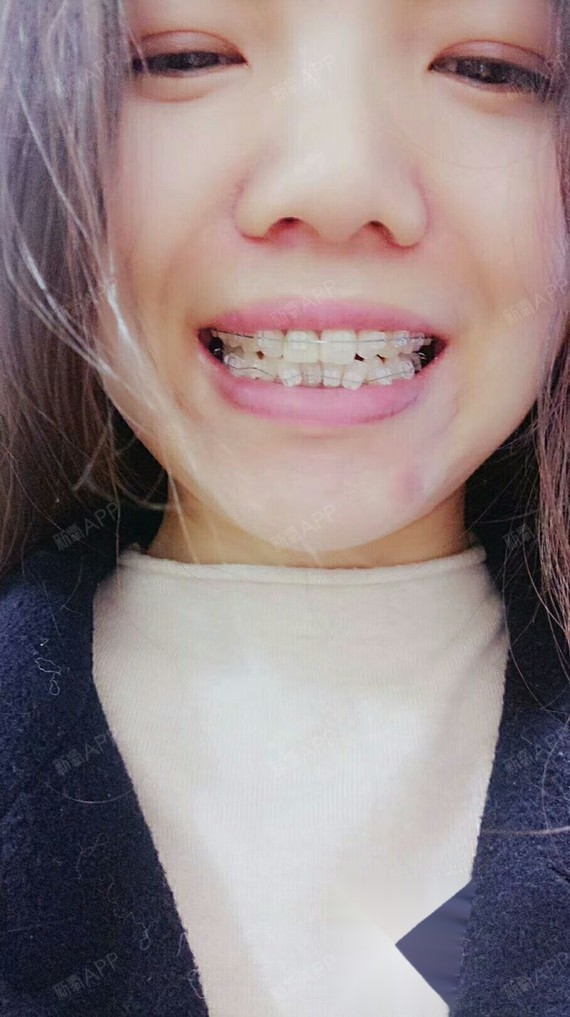牙齿矫正