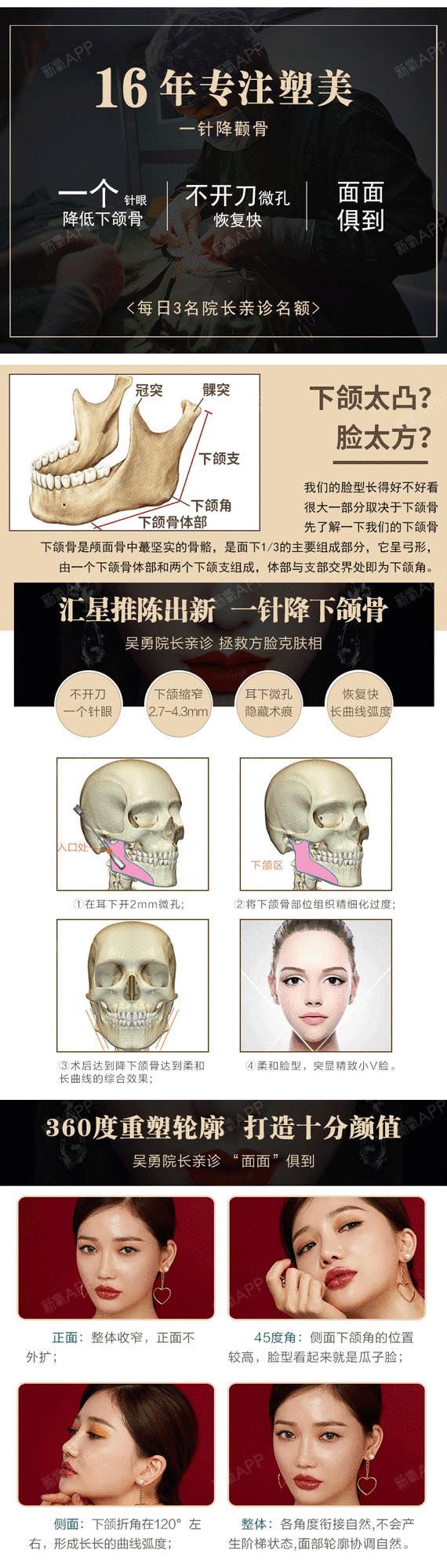 【私人定制【微创一针降下颌骨】2mm微创降下颌骨 脸方脸圆改小v脸