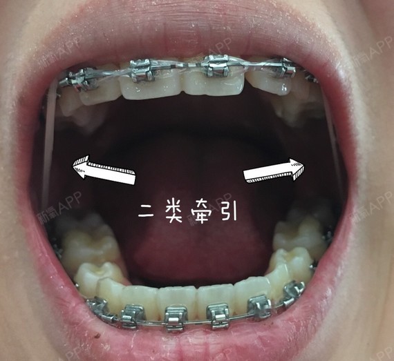 皮筋是二类牵引,从下面的八号牙挂到上面二三号牙之间的,一天换一个哈