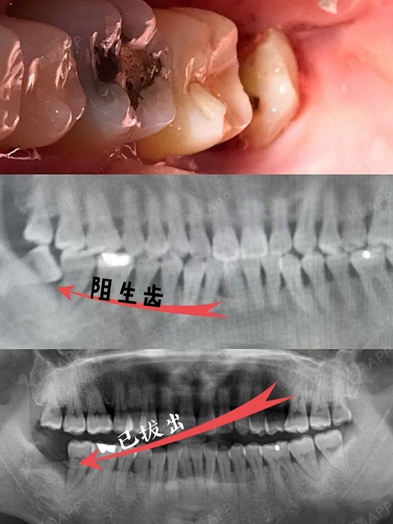 拔除智齿的过程是什么样的,会很痛吗?