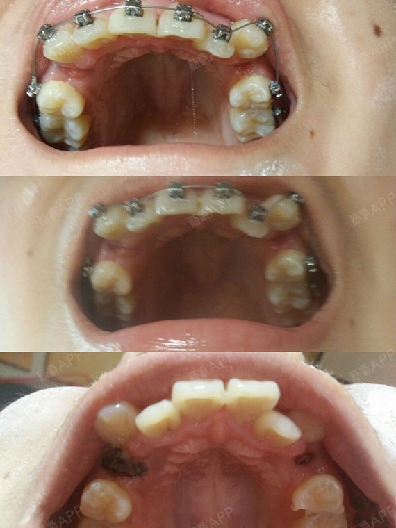 昨天已经拔了两颗四号牙,之后还要拔两颗,医生说我的牙齿过三个月应该