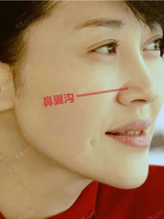 为了让大家听懂,也出现了一些流行词:鼻翼沟,海鸥线,双c线.