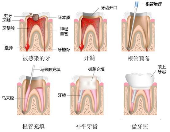 根管治疗为什么要"杀"牙神经