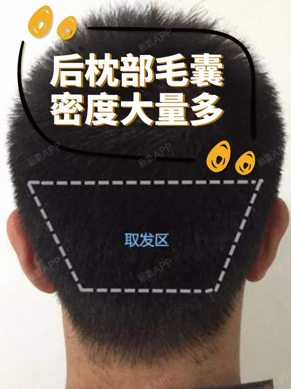 【植发趣识】——植发为何只能用后枕部的毛囊而不是