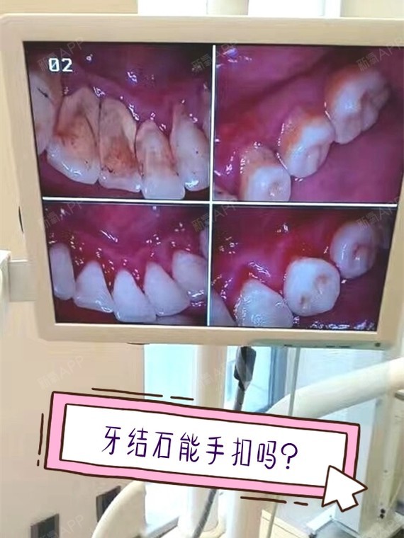 长了牙结石,用手抠是正确的操作吗?