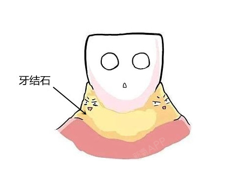 长了牙结石用手抠是正确的操作吗