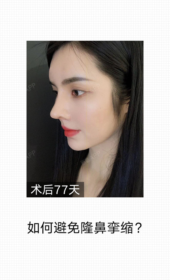 多数的鼻部整形会用到一种l型硅胶假体,l型硅胶假体植入不仅对鼻头