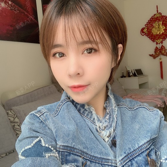 项目:自体脂肪全脸填充医生:杨硕成恢复:现在应该是
