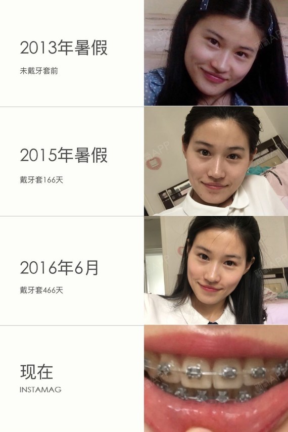 2016年6月11日笑起来的话会好一些不笑的时候会有牙套脸2016年7月下旬