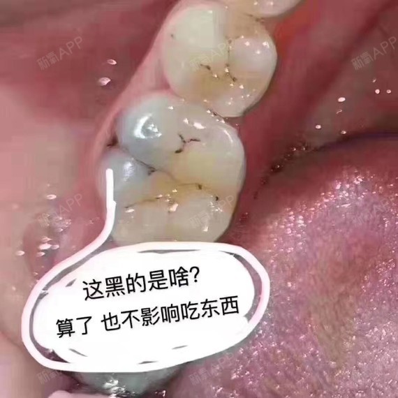 龋齿