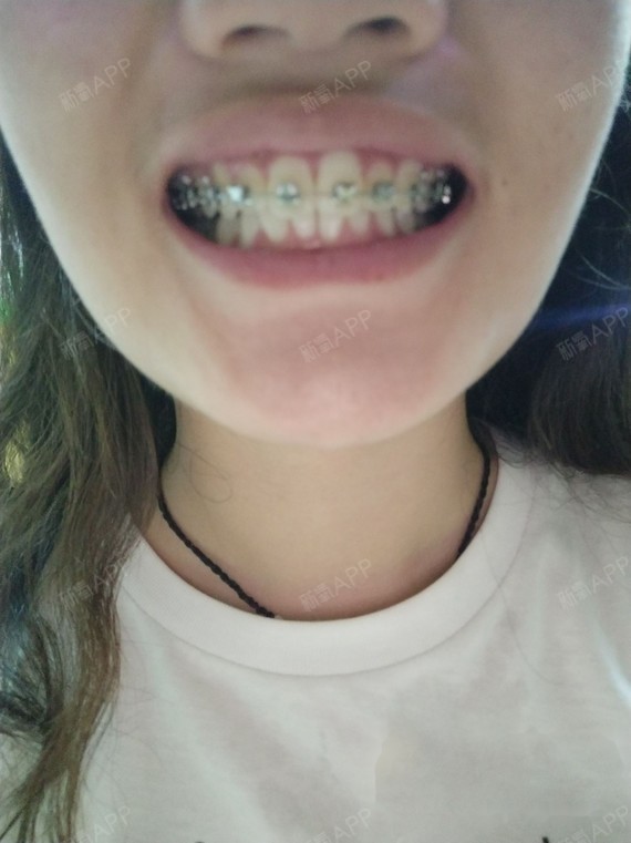 我拍了一张咬合的图
