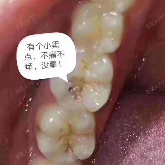 龋齿