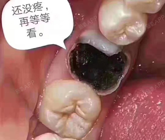 龋齿